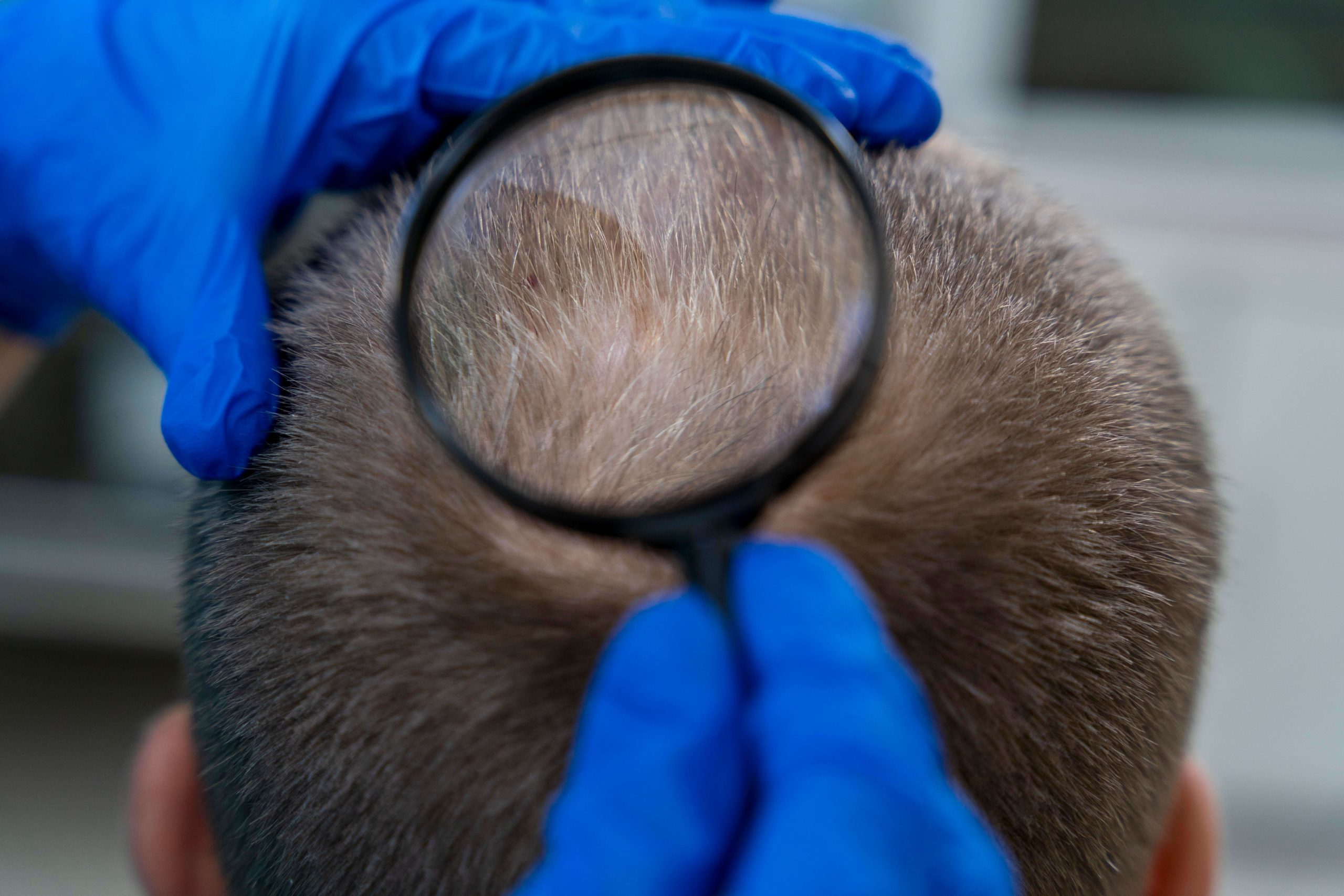 How to Get Rid of Demodex Mites on Scalp - Dr Gary Marder